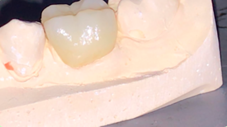 Alta estética dental