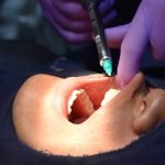 Inyectando anestesia a paciente