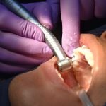 Tratamiento dental - Caries