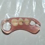 Prótesis dental removible