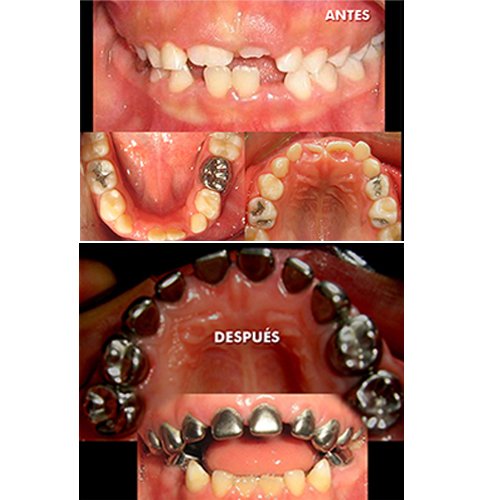 Tratamiento dental a niño