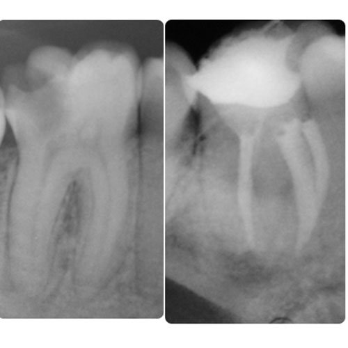 radiografia-endodoncia